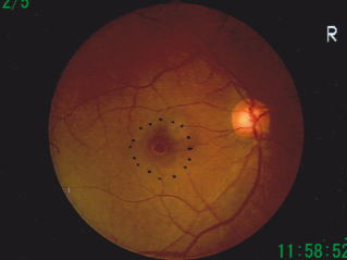 黄斑円孔、治療前