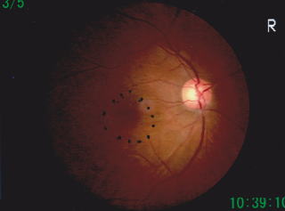 黄斑円孔、治療後